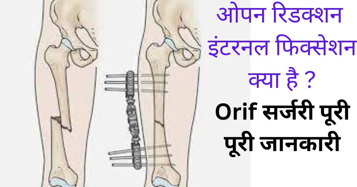 orif surgery