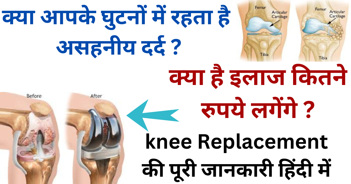 knee replacement surgery cost